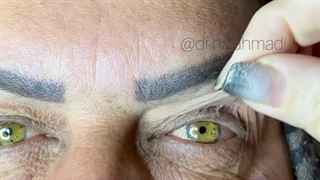 دکتر هانیه احمدی ساری جراحی پف زیر چشم