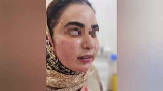 نمونه‌ای از تزریق چربی به صورت (5)