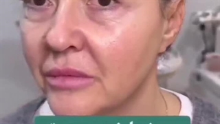 معجره لیفت صورت - جوانسازی پوست و صورت