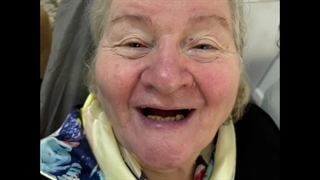 فیلم دندان مصنوعی تکی چسبی