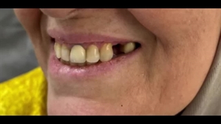 فیلم گذاشتن دندان مصنوعی ژله ای: تحویل 12 ساعته! 09353419752