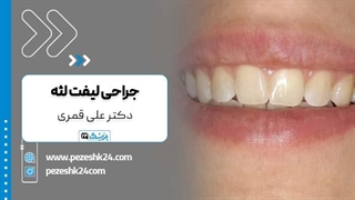 لیفت لثه با دکتر قمری در تهران لیزر صورت