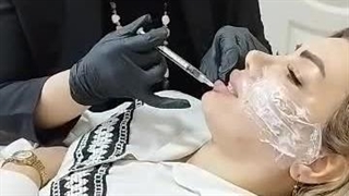 تزریق گونه و فیلر لب همزمان