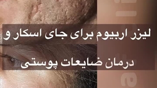 کلینیک پوست و مو و زیبایی صدف میکرونیدلینگ