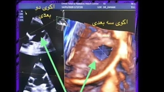 دکتر احمد وصال جراحی پف زیر چشم