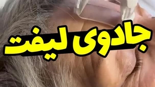 لیفت ابرو با دستگاه