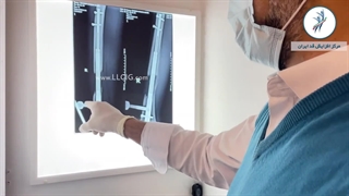 عمل افزایش قد با روش MTN -خروج پیج در مطب