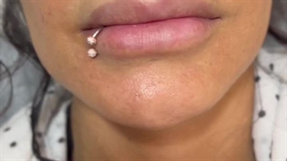 تزریق فیلر لب کلاسیک