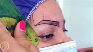 کلینیک کاشت موی رنسانس تهران