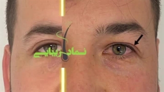 کلینیک کاشت موی نماد زیبایی تهران