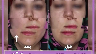 همه چیز درباره اندولیفت صورت