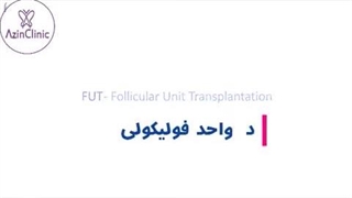 کاشت مو به روش FUT لیزر موهای زائد