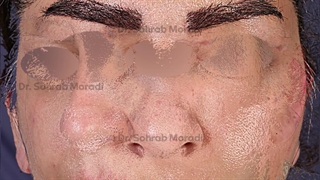 جراحة الأنف للدکتور مرادی