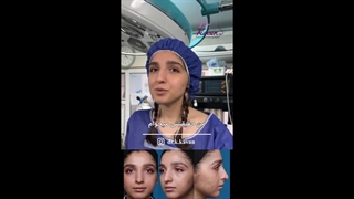 قبل و بلافاصله پس از عمل زیبایی بینی همراه با ورم زیاد