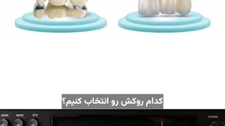 فرق روکشهای زیرکونیا و pfm