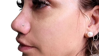 تزریق فیلر زاویه فک ، زاویه چانه و فیلر گونه همزمان