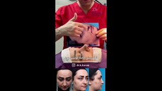 قبل و بلافاصله پس از عمل زیبایی بینی همراه با ورم زیاد