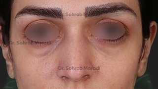 جراحة التجمیل الأنف فی طهران