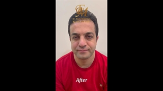 تزریق بوتاکس اصلاح طرح لبخند