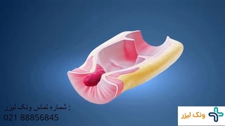 فیلم لیزر بواسیر