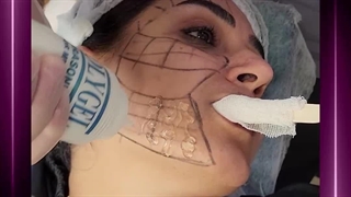 هایفوتراپی لیزر موهای زائد