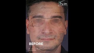 مباشرة بعد عملیة تجمیل الأنف