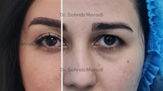 رفع الحاجب بالمنظار و تجمیل الأنف