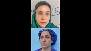 لیفت اندوسکوپی ابرو، عمل بینی و بلفاروپلاستی تحتانی