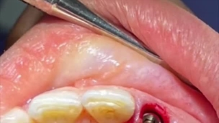 ایمپلنت فوری یا یک روزه