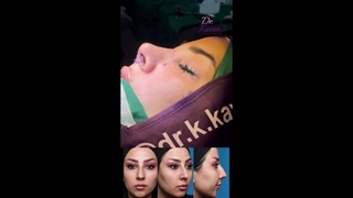 قبل و بلافاصله پس از عمل زیبایی بینی همراه با ورم زیاد