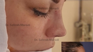 عملیة تجمیل الأنف فی طهران