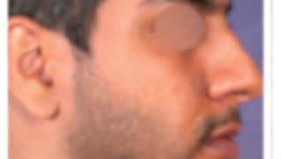 جراحة الأنف للرجال فی إیران