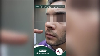 تحول چهره با کاشت ریش تخصصی در هلیا