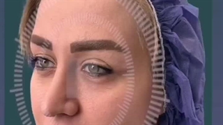 آموزش تزریق چربی به صورت با تکنیک جدید MD کد