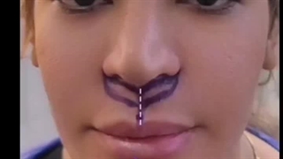 آموزش جراحی سانترال لب با مدرک معتبر و قابل ترجمه