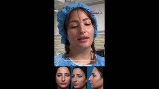 قبل و بلافاصله پس از عمل زیبایی بینی همراه با ورم زیاد