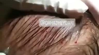 زهره حاج حیدری بهترین متخصص پوست ساری جوانسازی پوست
