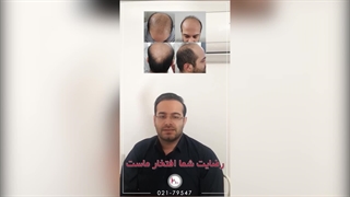 یک سال بعد از کاشت مو – این تغییر شگفت‌انگیز است!