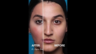 قبل و بعد عمل زیبایی بینی