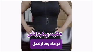 عمل ابدومینوپلاستی به همراه ماموپلاستی در مشهد