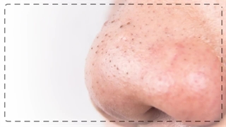 چگونه جوش‌های سر سیاه را از بین ببریم؟