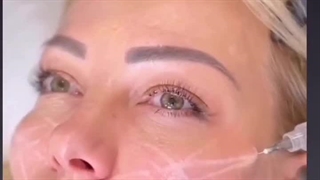 کامل ترین آموزش تزریق فیلر گونه با تکنیک لیفتینگ صورت