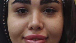 کاشت ابرو در کلینیک بهبد | انتخابی برای زیبایی طبیعی و ماندگار