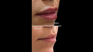 فرم دهی به لب