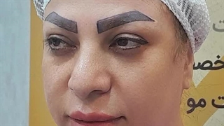 ویدیو کاشت ابرو طبیعی و دائمی در کلینیک بهبد | تغییرات شگفت‌انگیز در زیبایی چهره