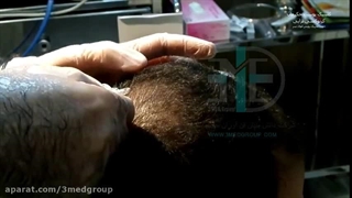 درمان ریزش مو با دستگاه پزشکی Carboxy Therapy