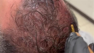 تزریق پی آر پی؛ روشی سریع و بدون درد برای تقویت مو