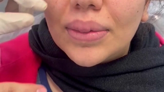 عوارض فاجعه بار فیلر لب کاشت مو