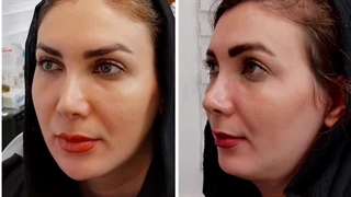 تزریق بوتاکس در کرج