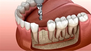 ایمپلنت دندان